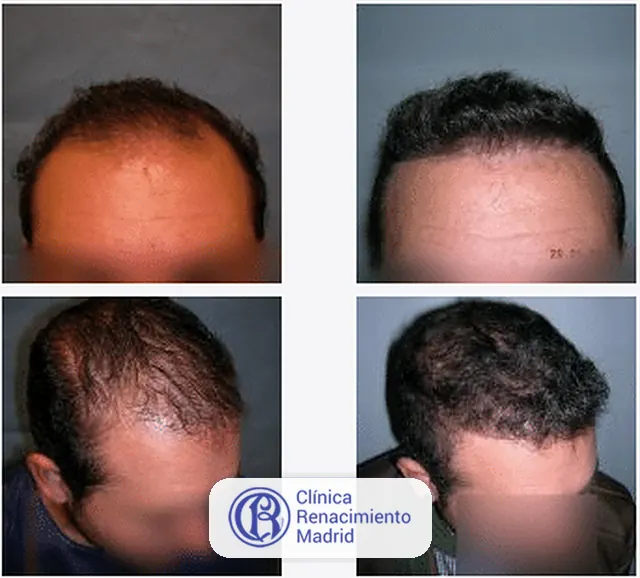 Caso real de implante de pelo en Madrid antes y después paciente 4 | Clínica Renacimiento Madrid