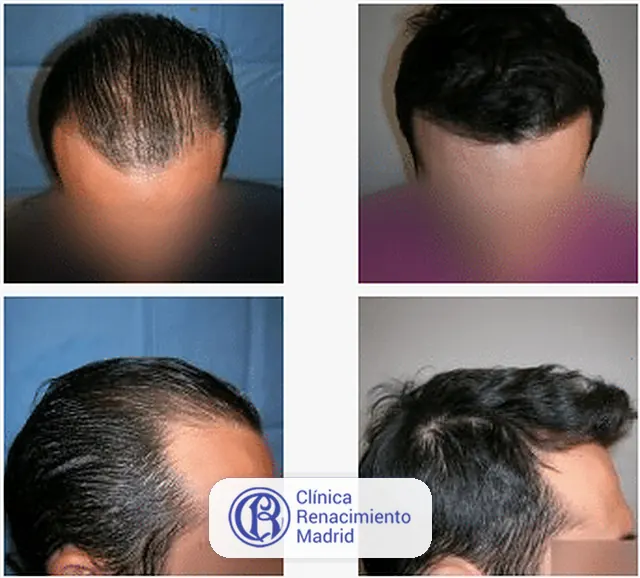 Caso real de implante de pelo en Madrid antes y después paciente 6 | Clínica Renacimiento Madrid
