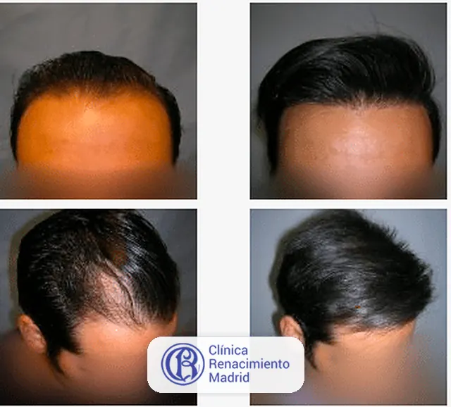 Caso real de implante de pelo en Madrid antes y después paciente 7 | Clínica Renacimiento Madrid