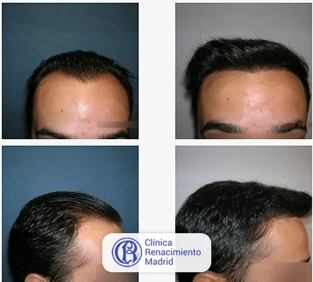 Caso real de implante de pelo en Madrid antes y después paciente 8 | Clínica Renacimiento Madrid