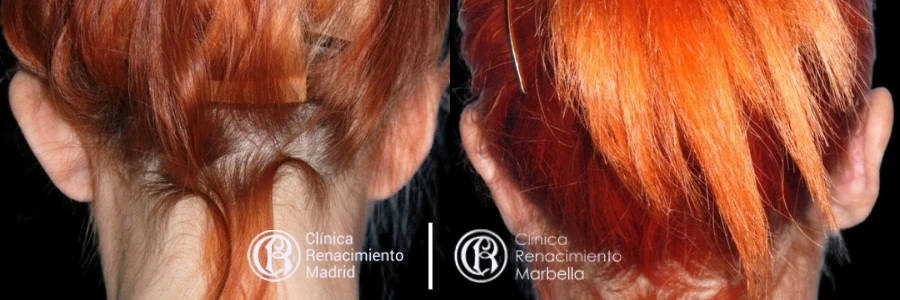 Caso real de Otoplastia en Madrid antes y después paciente 1 | Clínica Renacimiento Madrid