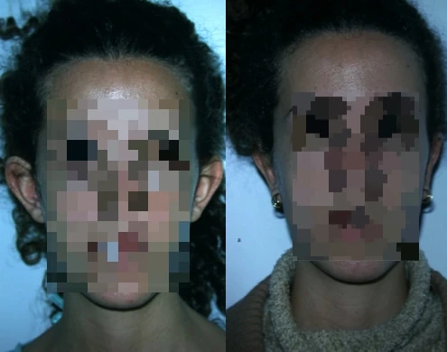 Caso real de Otoplastia en Madrid antes y después paciente 6 | Clínica Renacimiento Madrid