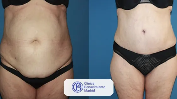 Caso real de abdominoplastia en Madrid antes y después paciente 1 | Clínica Renacimiento Madrid