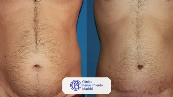 Caso real de abdominoplastia en Madrid antes y después paciente 6 | Clínica Renacimiento Madrid