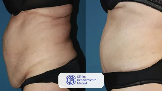 Caso real de abdominoplastia en Madrid antes y después paciente 2 | Clínica Renacimiento Madrid