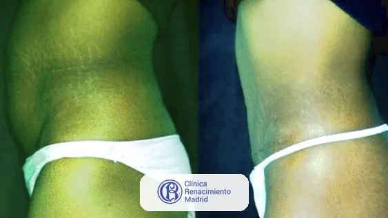 Caso real de abdominoplastia en Madrid antes y después paciente 4 | Clínica Renacimiento Madrid