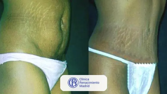 Caso real de abdominoplastia en Madrid antes y después paciente 5 | Clínica Renacimiento Madrid