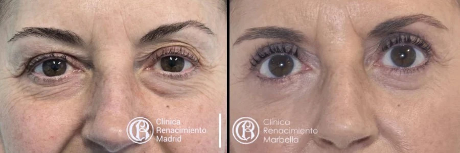 Caso real de blefaroplastia en Madrid antes y después, rejuvenecimiento de la mirada paciente 1 | Clínica Renacimiento Madrid