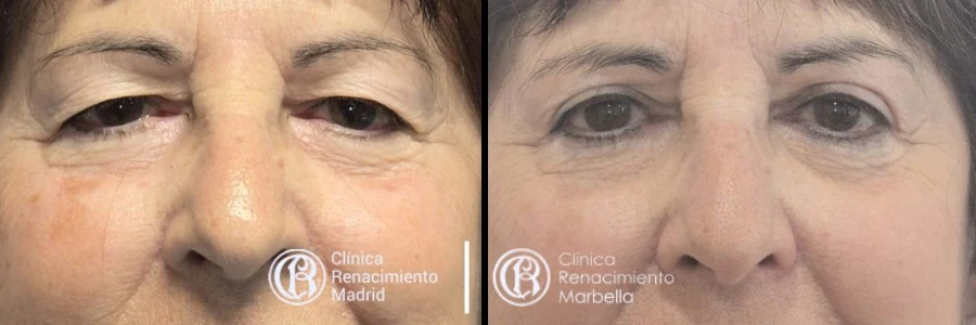 Antes y después de cirugía de párpados en Madrid, blefaroplastia paciente 2 | Clínica Renacimiento Madrid