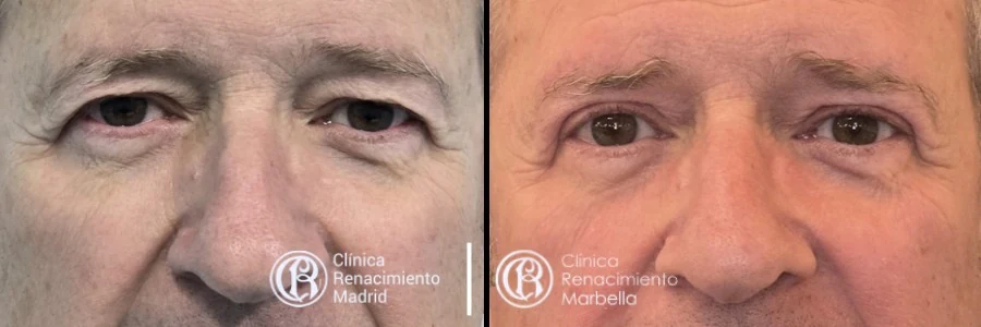 Caso real de blefaroplastia inferior y superior en Madrid paciente 3 | Clínica Renacimiento Madrid