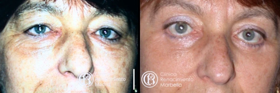 Comparativa real de blefaroplastia en Madrid antes y después paciente 4 | Clínica Renacimiento Madrid