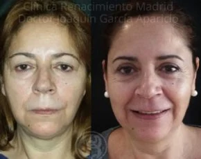 Blefaroplastia en Madrid caso real antes y después paciente 5 | Clínica Renacimiento Madrid