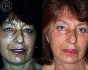 Cirugía de párpados en Madrid antes y después paciente 6 | Clínica Renacimiento Madrid