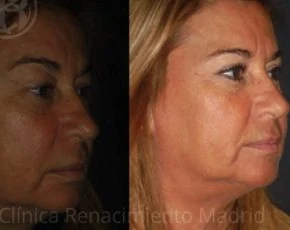 Caso real de blefaroplastia estética en Madrid antes y después paciente 7 | Clínica Renacimiento Madrid