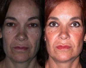 Resultado de blefaroplastia en Madrid antes y después paciente 8 | Clínica Renacimiento Madrid