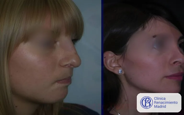 Caso real de Bichectomía / Bolas de Bichat en Madrid vista de perfil antes y después | Clínica Renacimiento Madrid