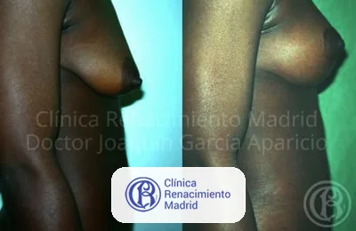 Caso real de elevación de senos mastopexia en Madrid antes y después paciente 5 | Clínica Renacimiento Madrid