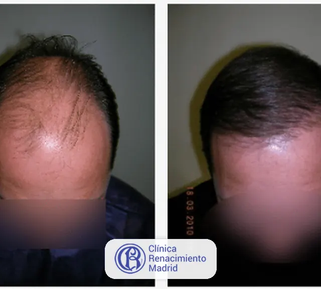 Caso real de implante de pelo en Madrid antes y después paciente 1 | Clínica Renacimiento Madrid