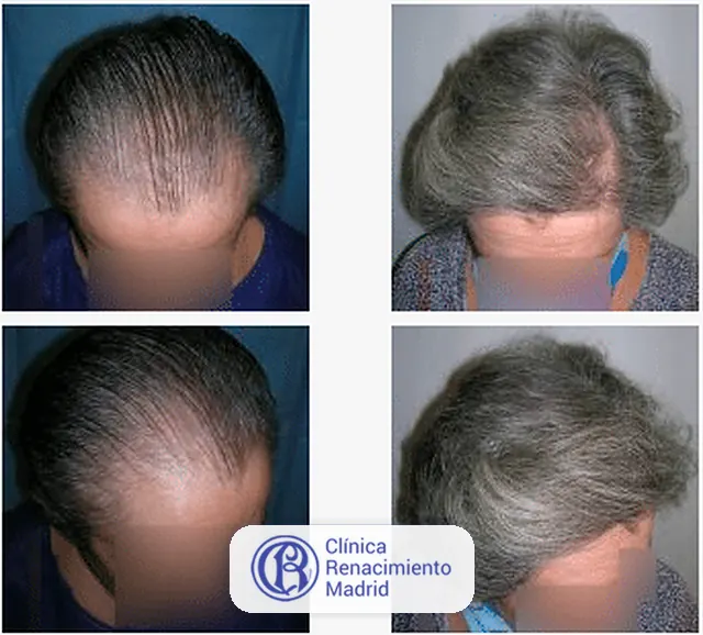 Caso real de implante de pelo en Madrid antes y después paciente 2 | Clínica Renacimiento Madrid