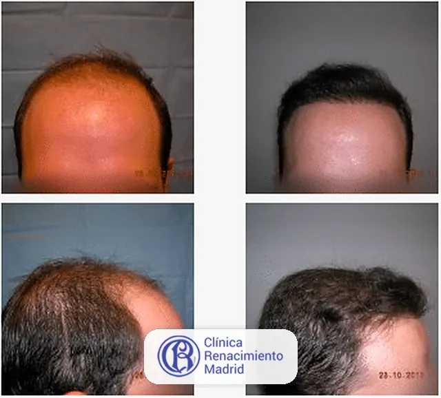 Caso real de implante de pelo en Madrid antes y después paciente 3 | Clínica Renacimiento Madrid