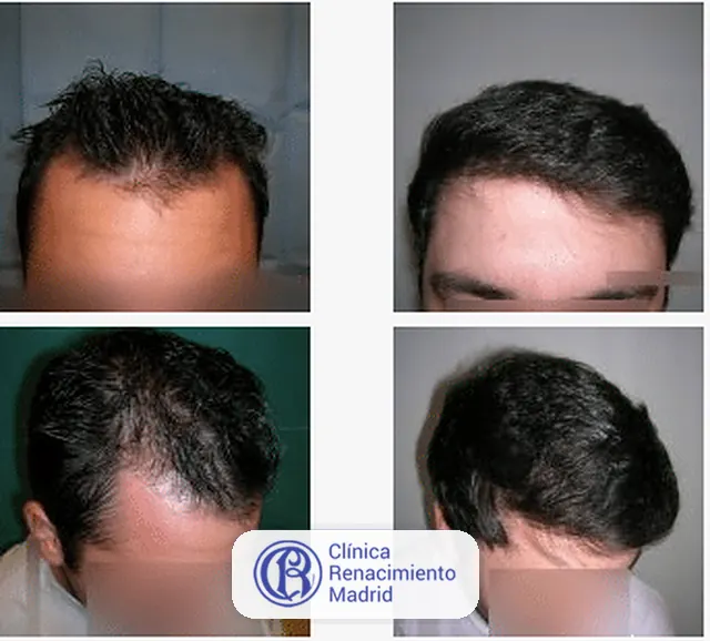 Caso real de implante de pelo en Madrid antes y después paciente 5 | Clínica Renacimiento Madrid