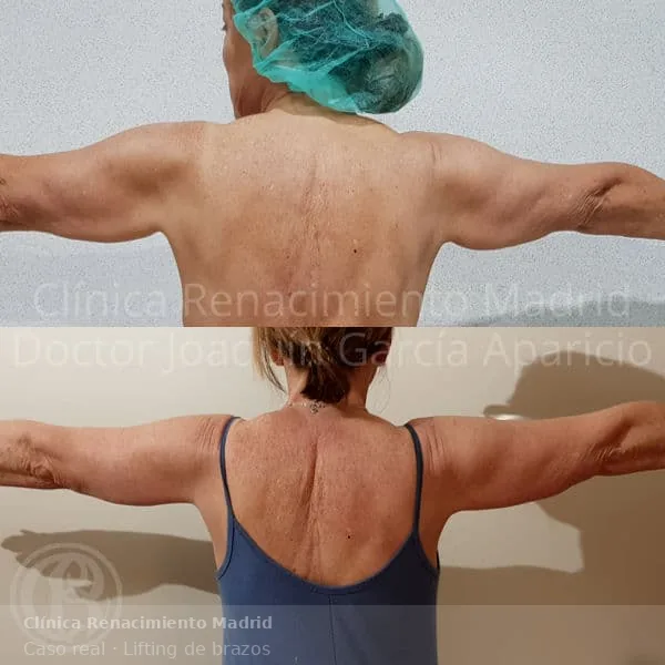 Caso real de braquioplastia o lifting de brazos en Clínica Renacimiento Madrid y Marbella