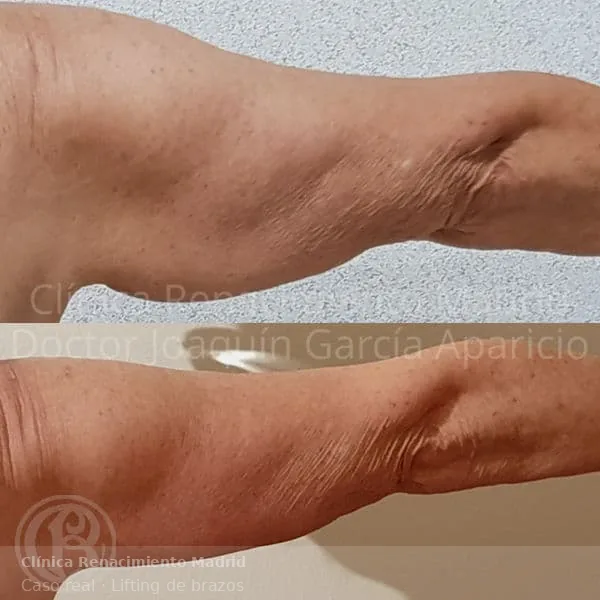 Antes y después de redefinición de brazos mediante braquioplastia en Madrid