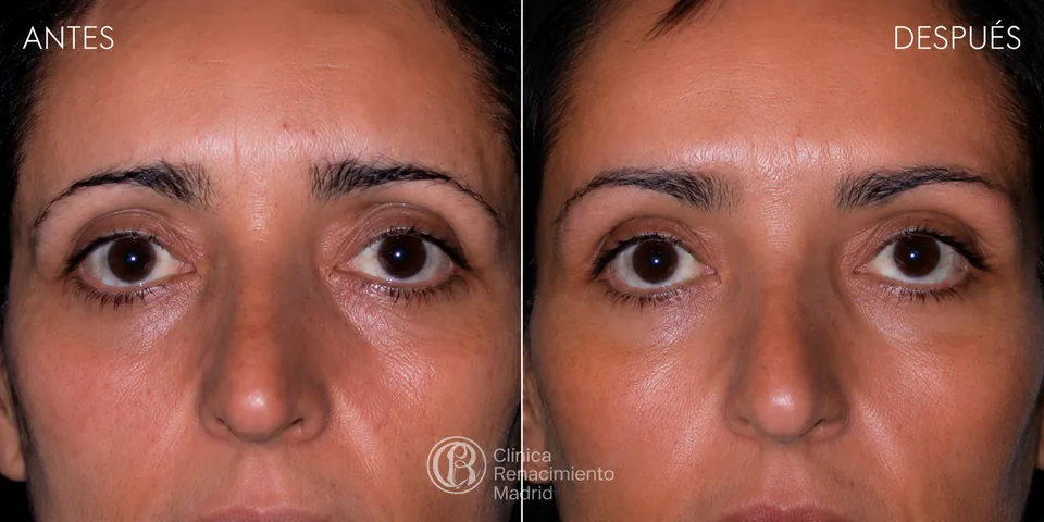 Caso real de lifting de cejas en Madrid antes y después zona de la mirada | Clínica Renacimiento Madrid