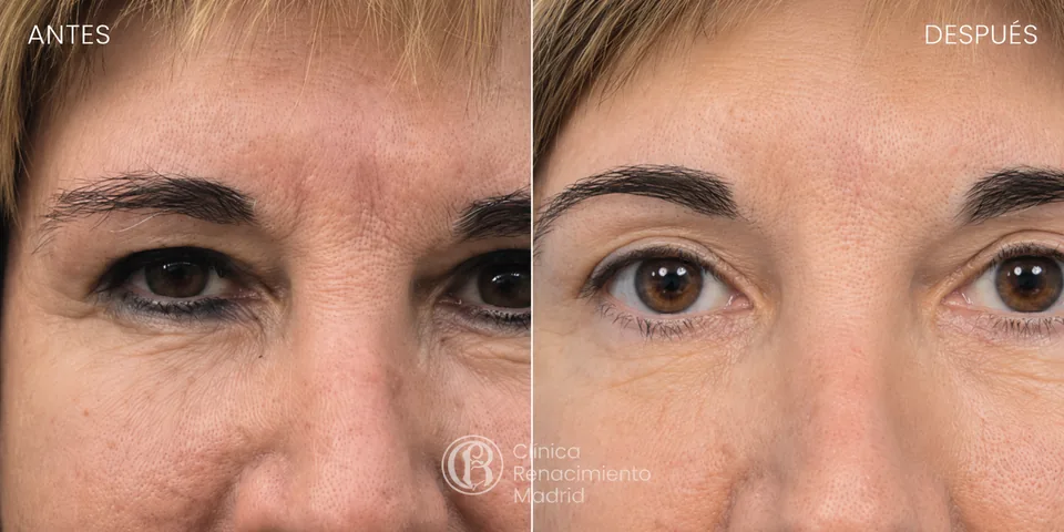 Antes y después de lifting de cejas en Madrid rejuvenecimiento de la mirada | Clínica Renacimiento Madrid