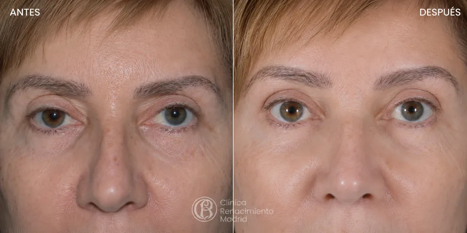 Resultado de lifting de cejas en Madrid comparativa antes y después | Clínica Renacimiento Madrid