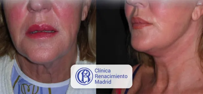 Antes y después de lifting de cuello en Madrid caso real 1 | Clínica Renacimiento Madrid