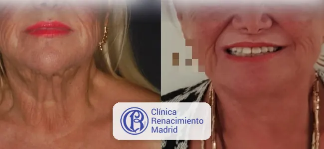 Antes y después de lifting cervical en Madrid caso real 2 | Clínica Renacimiento Madrid