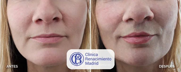 Caso real de Lifting de labios en Madrid antes y después paciente 1 | Clínica Renacimiento Madrid