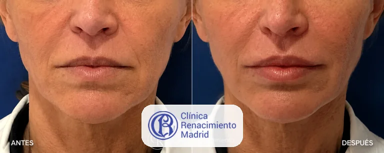 Caso real de Lip Lift en Madrid antes y después paciente 2 | Clínica Renacimiento Madrid