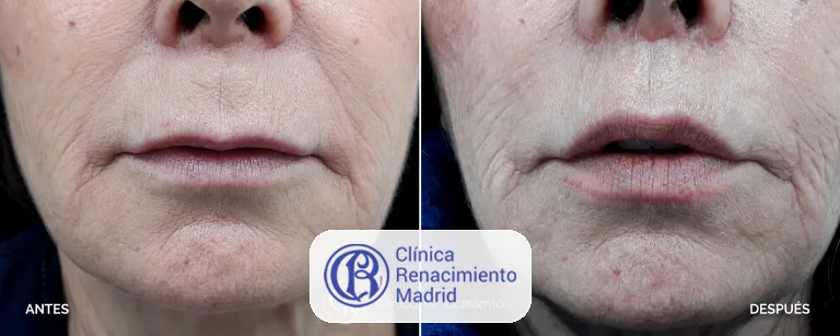 Caso real de lifting de labio superior en Madrid antes y después paciente 3 | Clínica Renacimiento Madrid