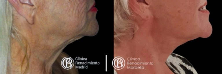 Caso real de lifting facial en Madrid antes y después, perfil de cuello y óvalo facial paciente 1 | Clínica Renacimiento Madrid