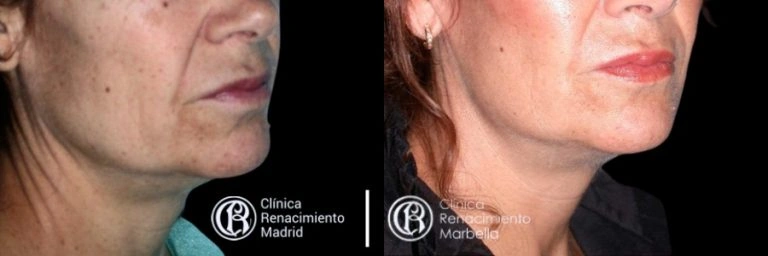 Comparativa real de lifting facial en Madrid antes y después paciente 3 | Clínica Renacimiento Madrid