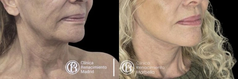 Antes y después de lifting facial en Madrid, redefinición del cuello y la línea mandibular paciente 4 | Clínica Renacimiento Madrid