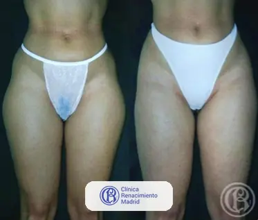 Caso real de lipoescultura y liposucción en Madrid antes y después caso 1 | Clínica Renacimiento Madrid