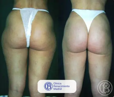 Caso real de lipoescultura y liposucción en Madrid antes y después caso 2 | Clínica Renacimiento Madrid