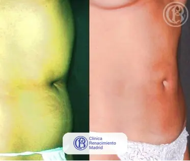 Caso real de lipoescultura y liposucción en Madrid antes y después caso 3 | Clínica Renacimiento Madrid