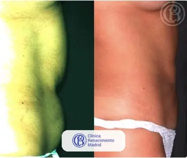 Caso real de lipoescultura y liposucción en Madrid antes y después caso 4 | Clínica Renacimiento Madrid