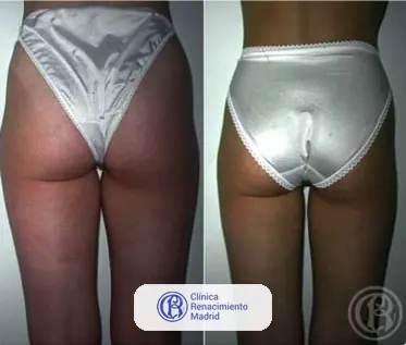 Caso real de lipoescultura y liposucción en Madrid antes y después caso 5 | Clínica Renacimiento Madrid