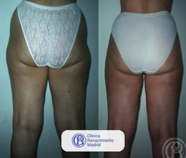 Caso real de lipoescultura y liposucción en Madrid antes y después caso 6 | Clínica Renacimiento Madrid