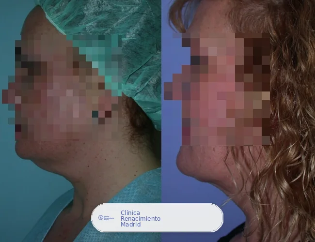Caso real de lipoescultura de papada en Madrid antes y después | Clínica Renacimiento Madrid