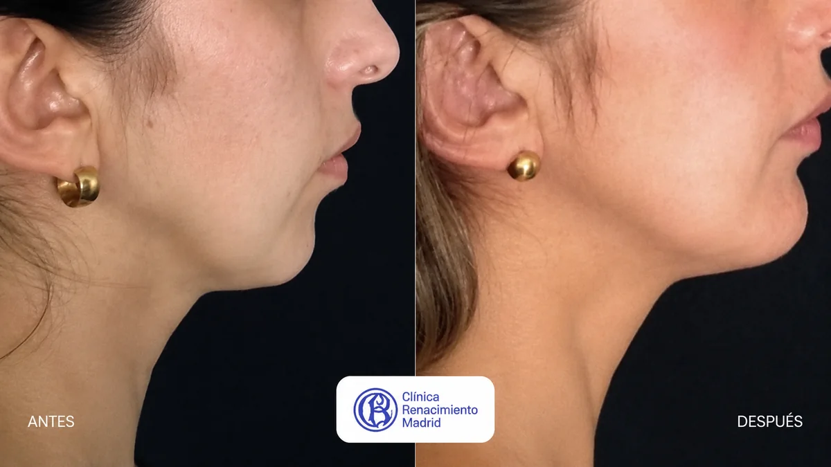 Caso real de cirugía de mentón en Madrid antes y después, perfil femenino con mejora de la línea mandibular | Clínica Renacimiento Madrid