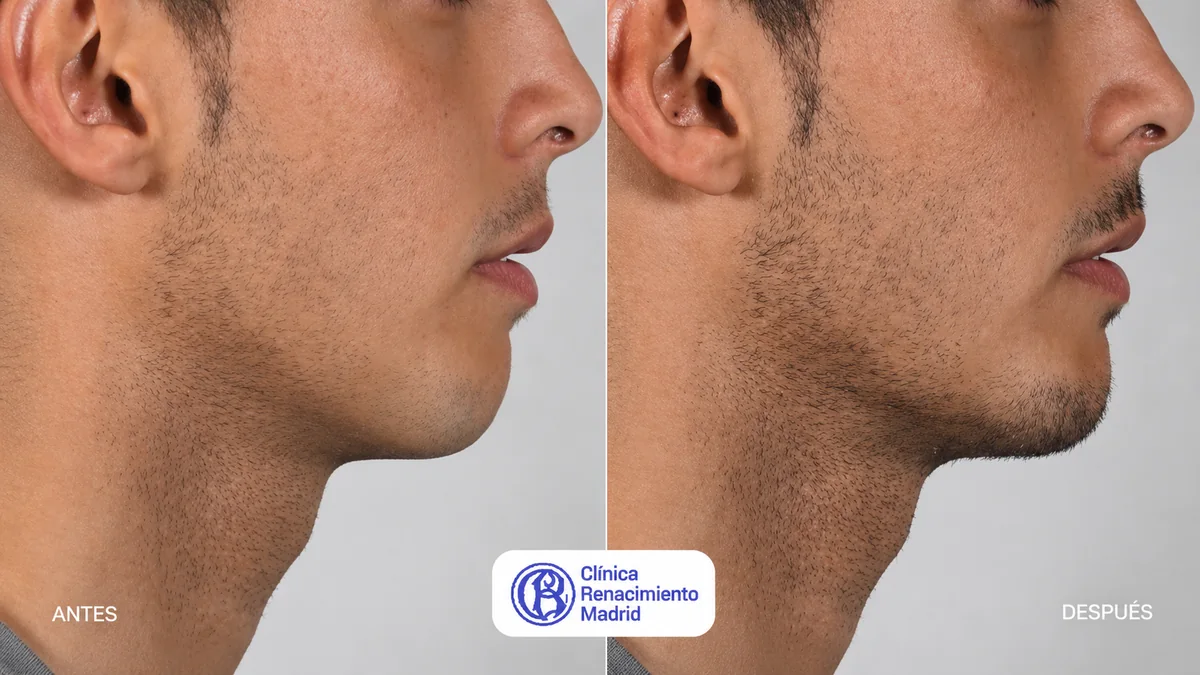 Caso real de mentoplastia masculina en Madrid antes y después, perfil y mentón proporcionado | Clínica Renacimiento Madrid