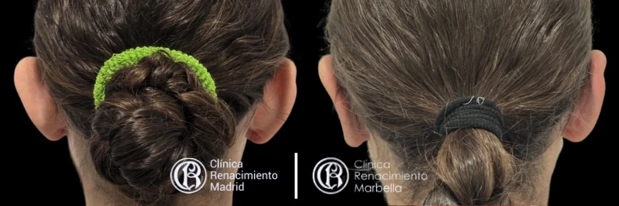 Caso real de Otoplastia en Madrid antes y después paciente 2 | Clínica Renacimiento Madrid