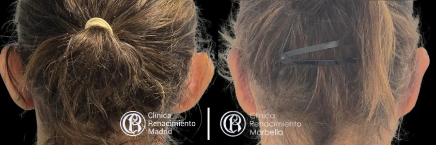 Caso real de Otoplastia en Madrid antes y después paciente 3 | Clínica Renacimiento Madrid