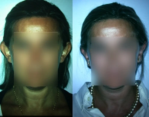Caso real de Otoplastia en Madrid antes y después paciente 4 | Clínica Renacimiento Madrid